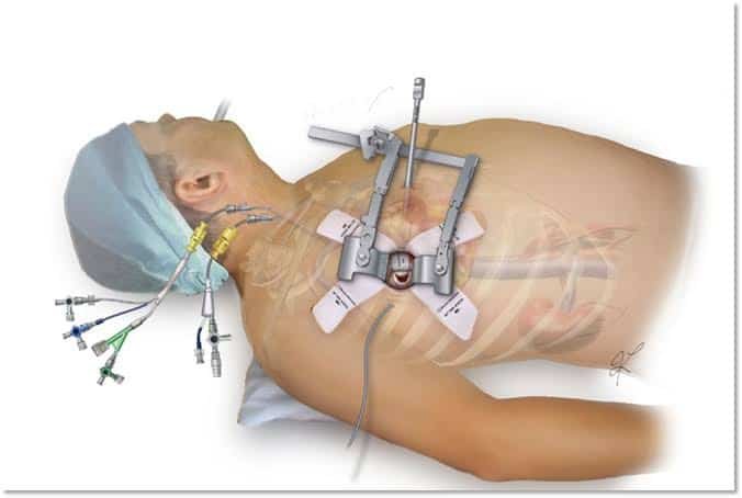 جراحة القلب بالمنظار: أحدث تقنيات جراحة القلب طفيفة التوغل
