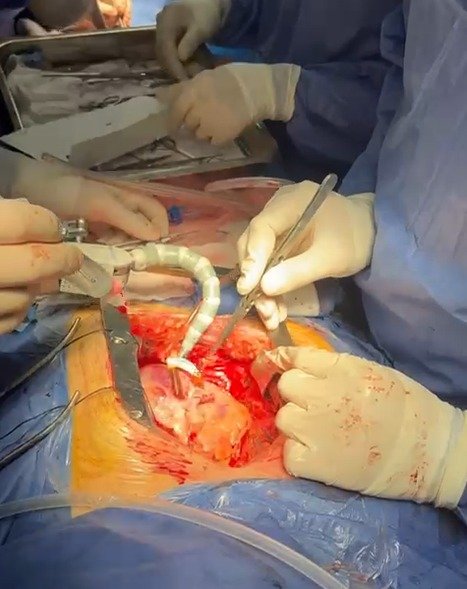 جراحة القلب النابض