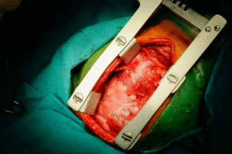 جراحة القلب المفتوح