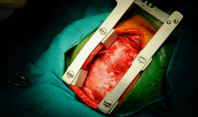 جراحة القلب المفتوح