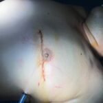 نسبة نجاح جراحة القلب النابض