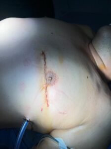 نسبة نجاح جراحة القلب النابض