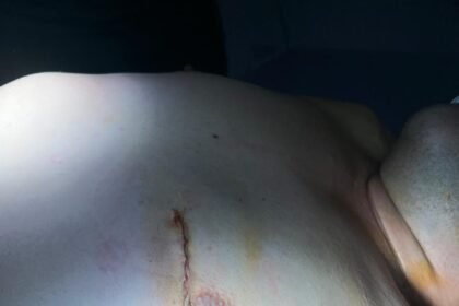 نسبة نجاح جراحة القلب النابض