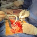 جراحة القلب النابض