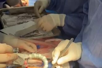 جراحة القلب النابض